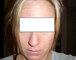 Before restylane